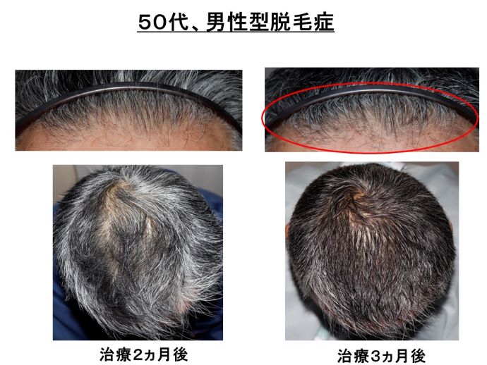 円形脱毛症　病院